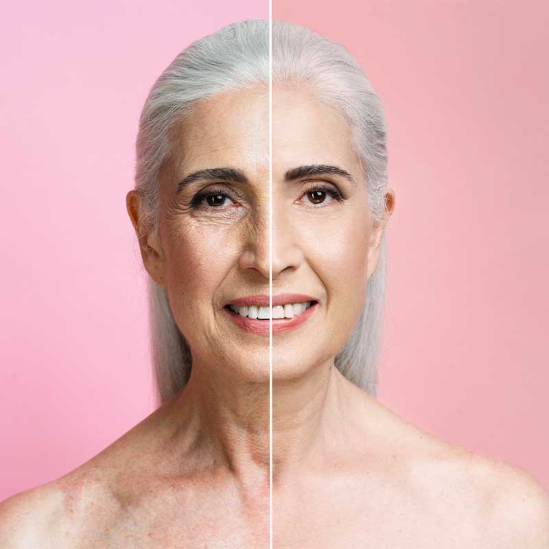 Dermapen Wien, Microneedling, Microneedling Falten, Microneedling Akne