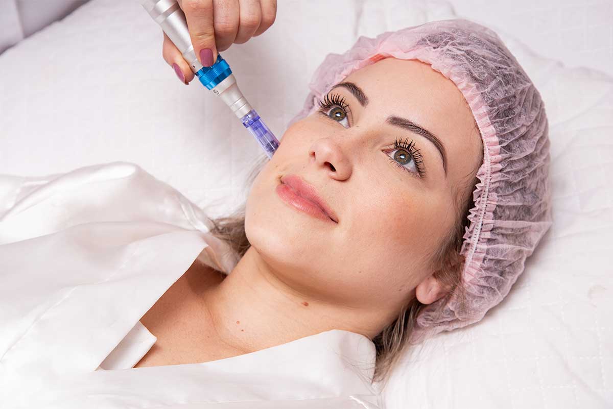 Micro needling Wien, Microneedling wien 1100, Kosmetikstudio Wien 1100