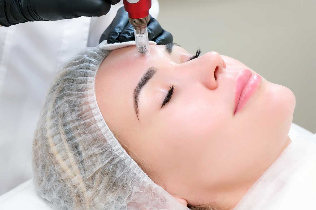 Microneedling Behandlung Wien, Microneedling Kosmetikerin, Dermapen Behandlung Wien